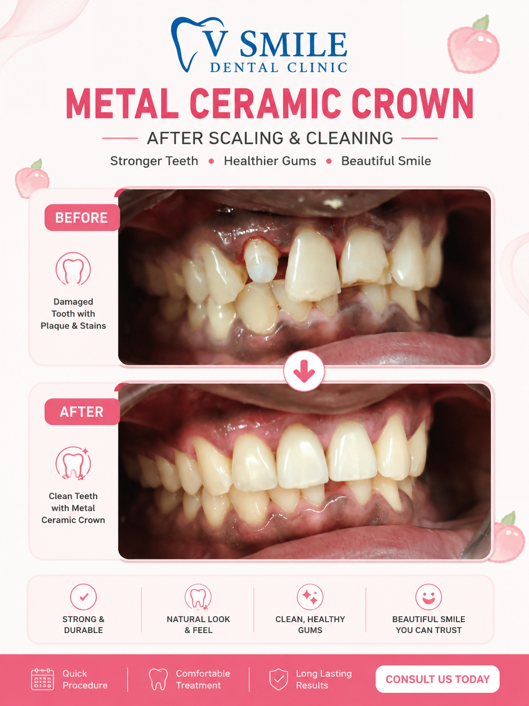 Metal ceramic crown before and after