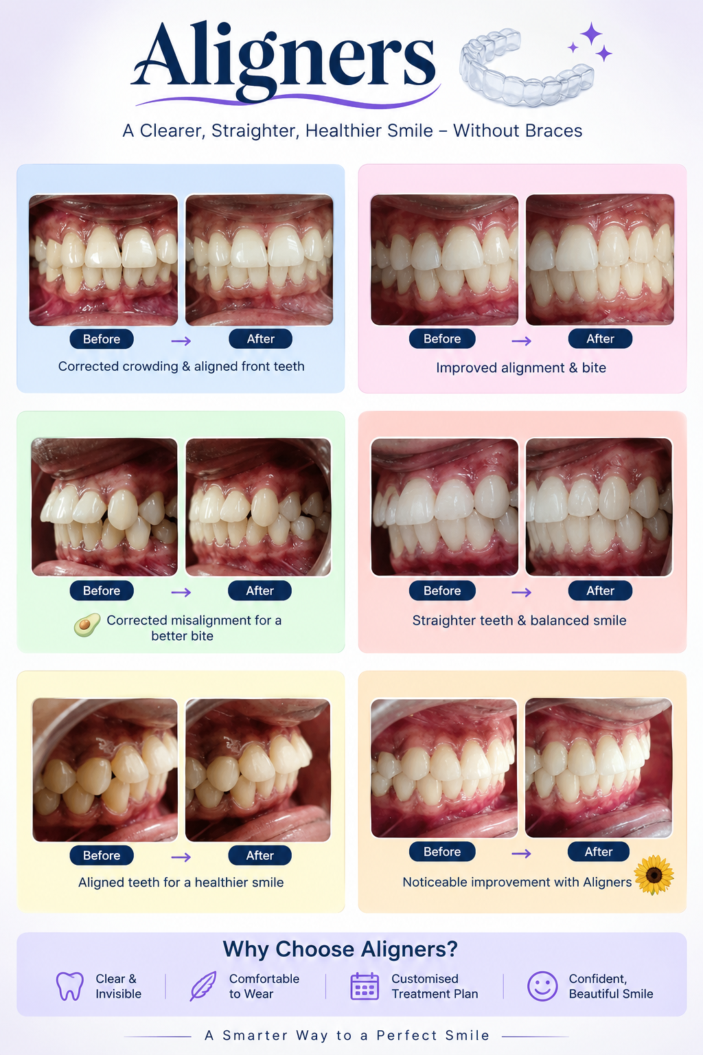 Clear aligners before and after, corrected crowding