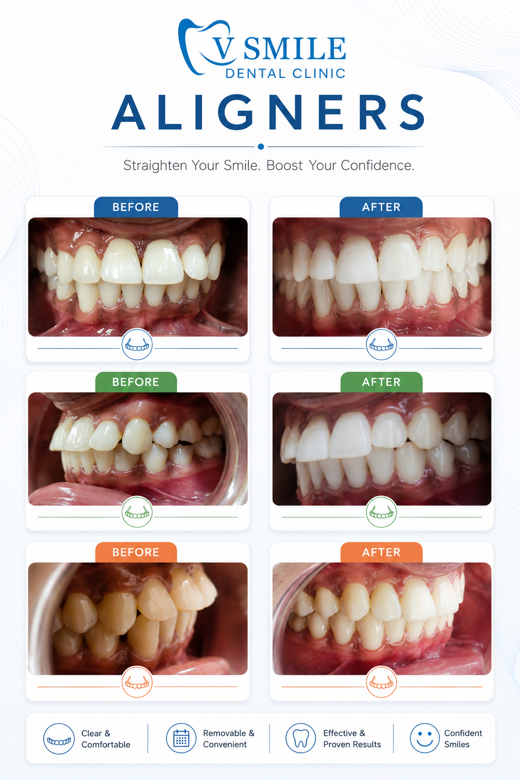 Clear aligners before and after, full smile correction