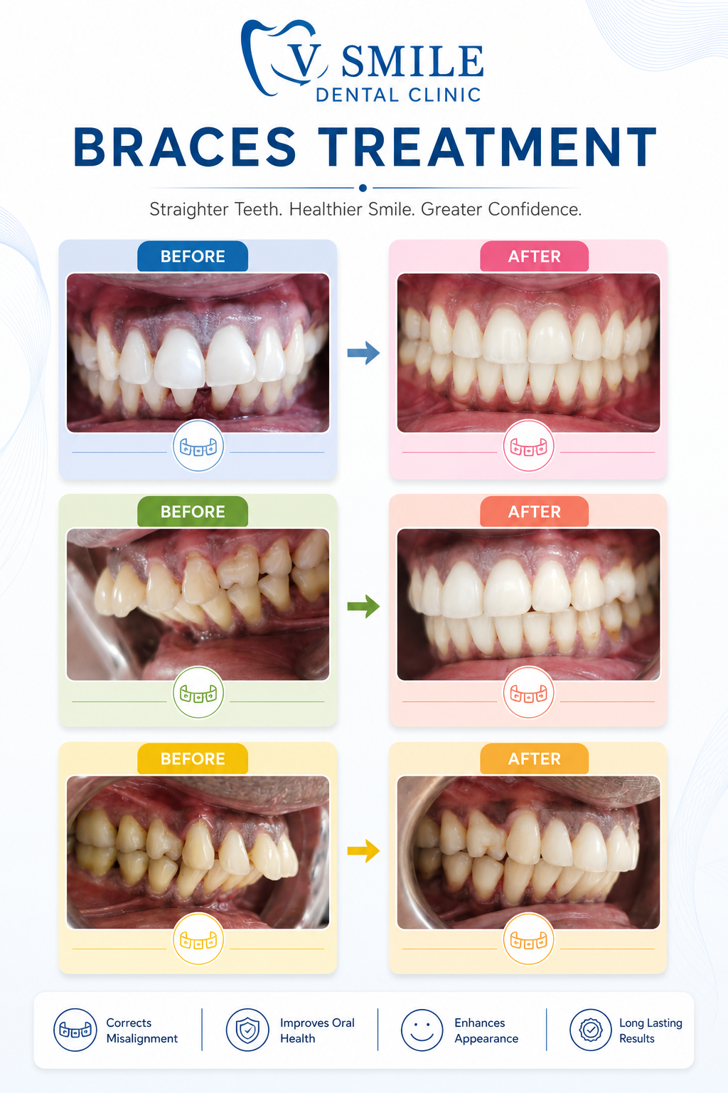 Braces treatment before and after