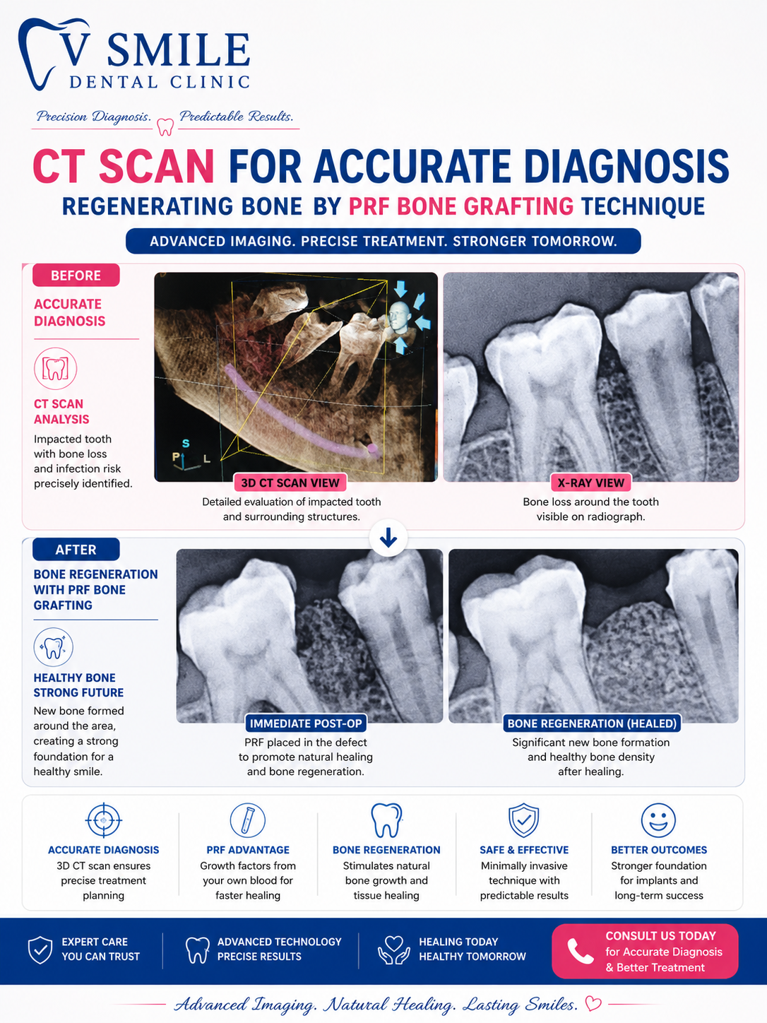 CT scan for accurate diagnosis and PRF bone grafting