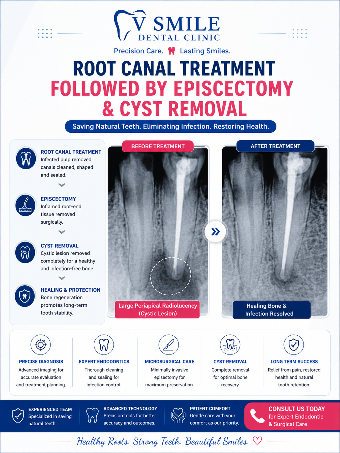 Root canal treatment followed by apicoectomy and cyst removal