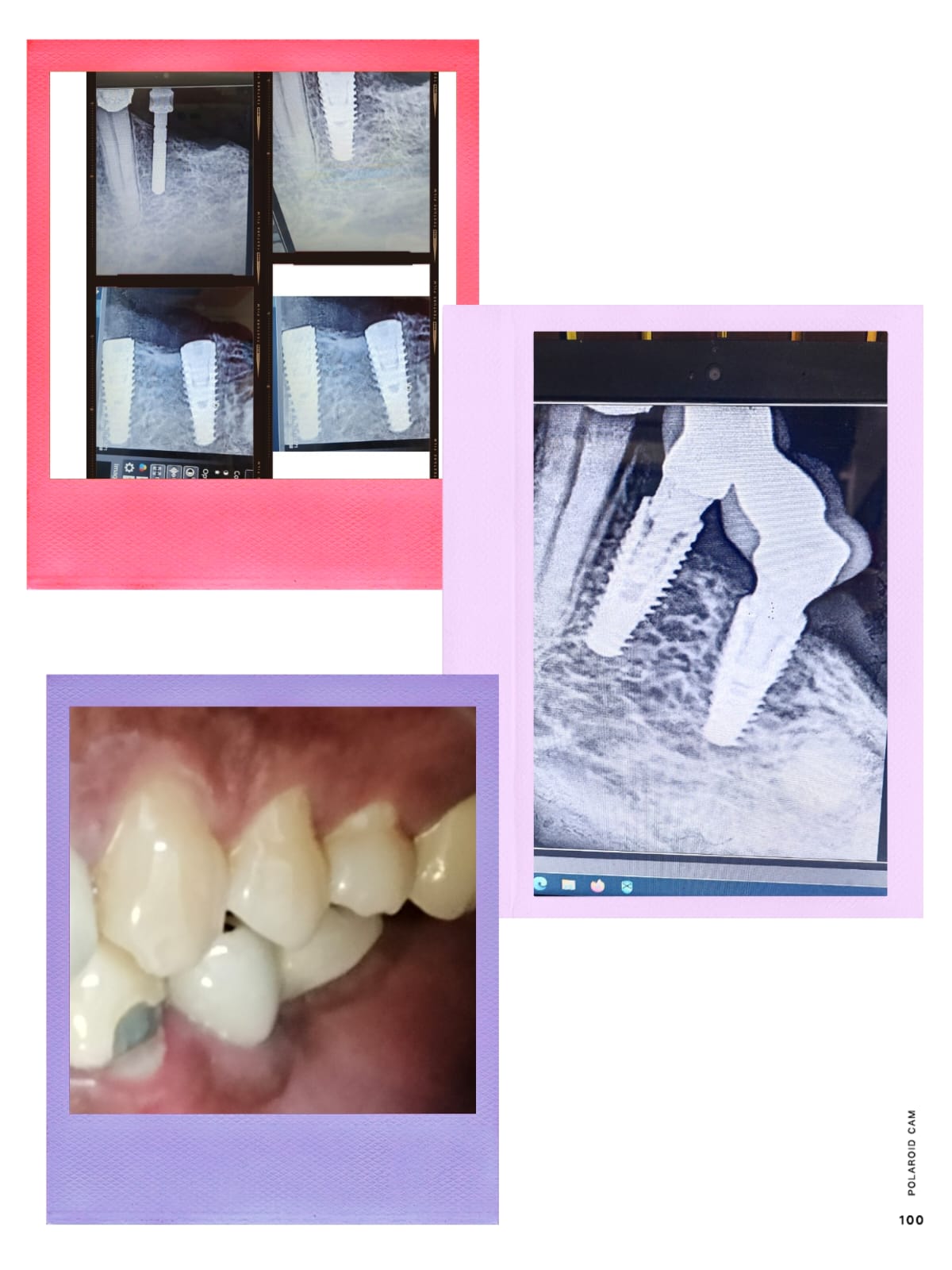 Dental implant placement with full functionality